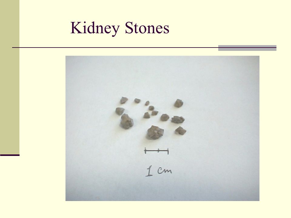 Jeanine azzo solubility kidney stones and salts